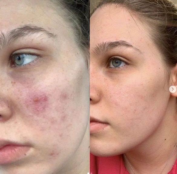 Acne Before & After Photo